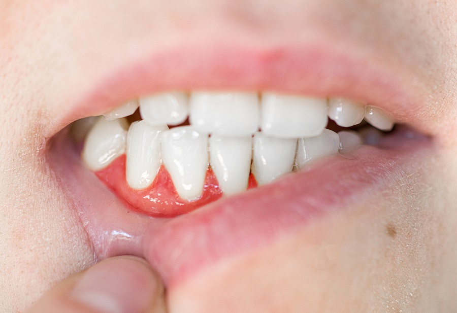 Diabetes and Gum Disease: A Silent Connection That Demands Attention!