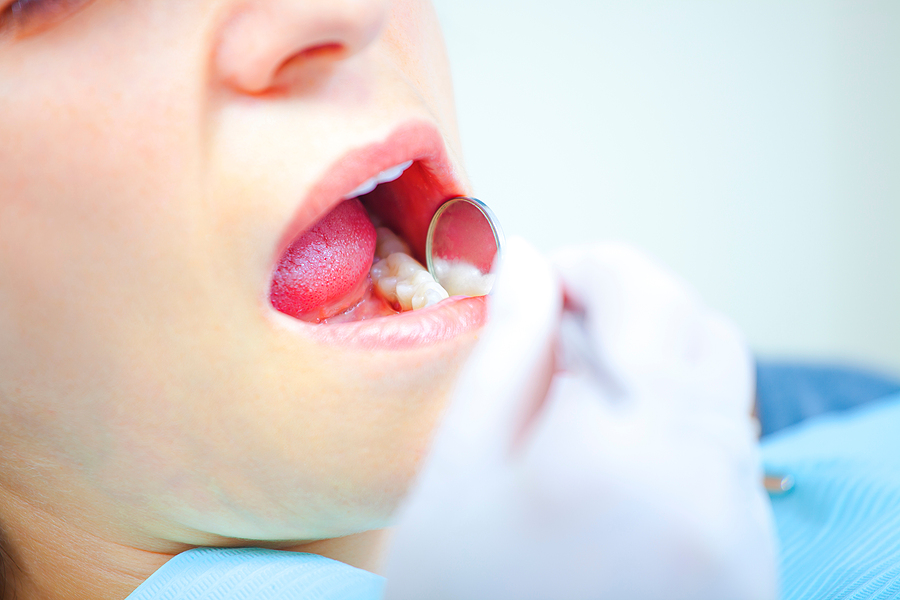 A Comprehensive Guide to Full-Mouth Reconstruction in Atlanta, GA: Restoring Your Smile and Oral Health
