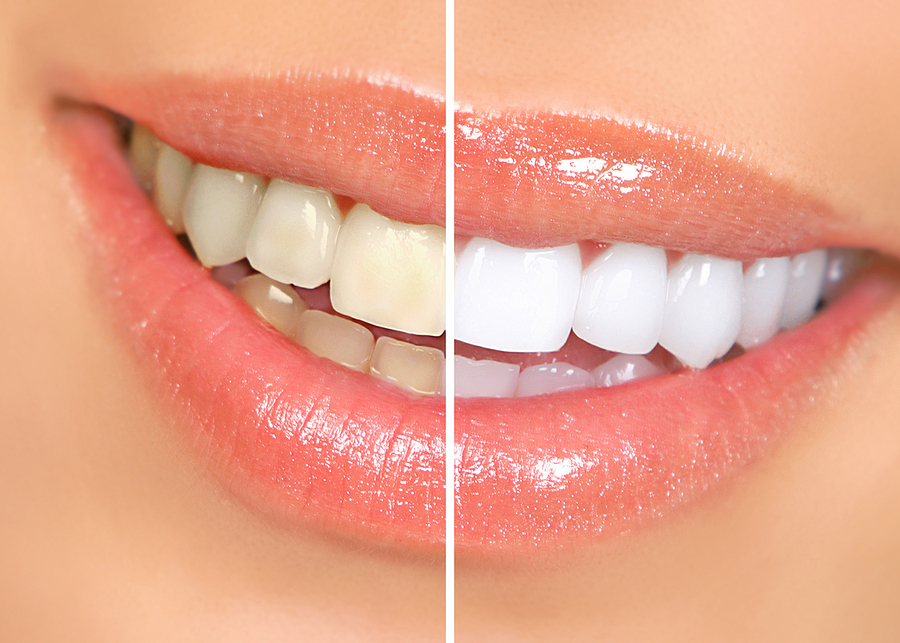 Achieve a Brighter Smile with Teeth Whitening in Atlanta, GA