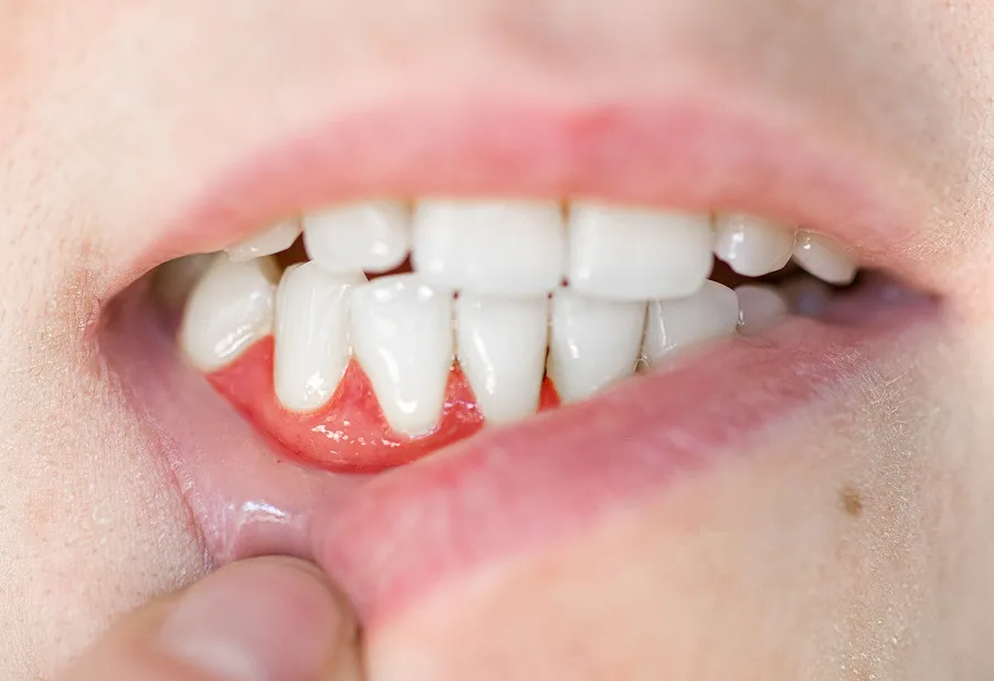 Diabetes and Gum Disease: A Silent Connection That Demands Attention!