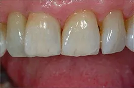 dentalimplantafter2