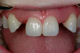 dentalimplantbefore1