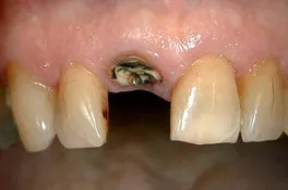 dentalimplantbefore2