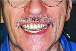 dentalimplantbefore3