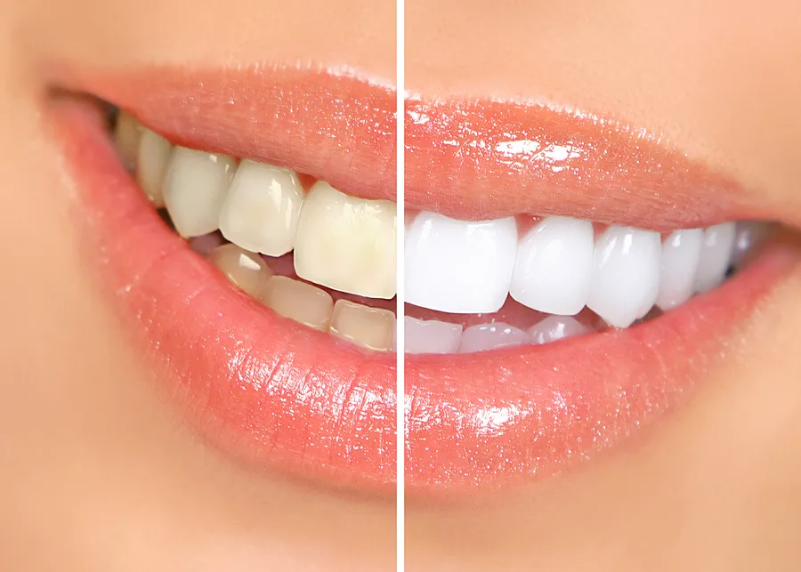 Achieve a Brighter Smile with Teeth Whitening